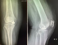 Mini-Implantat verhilft zur gewohnten Mobilität